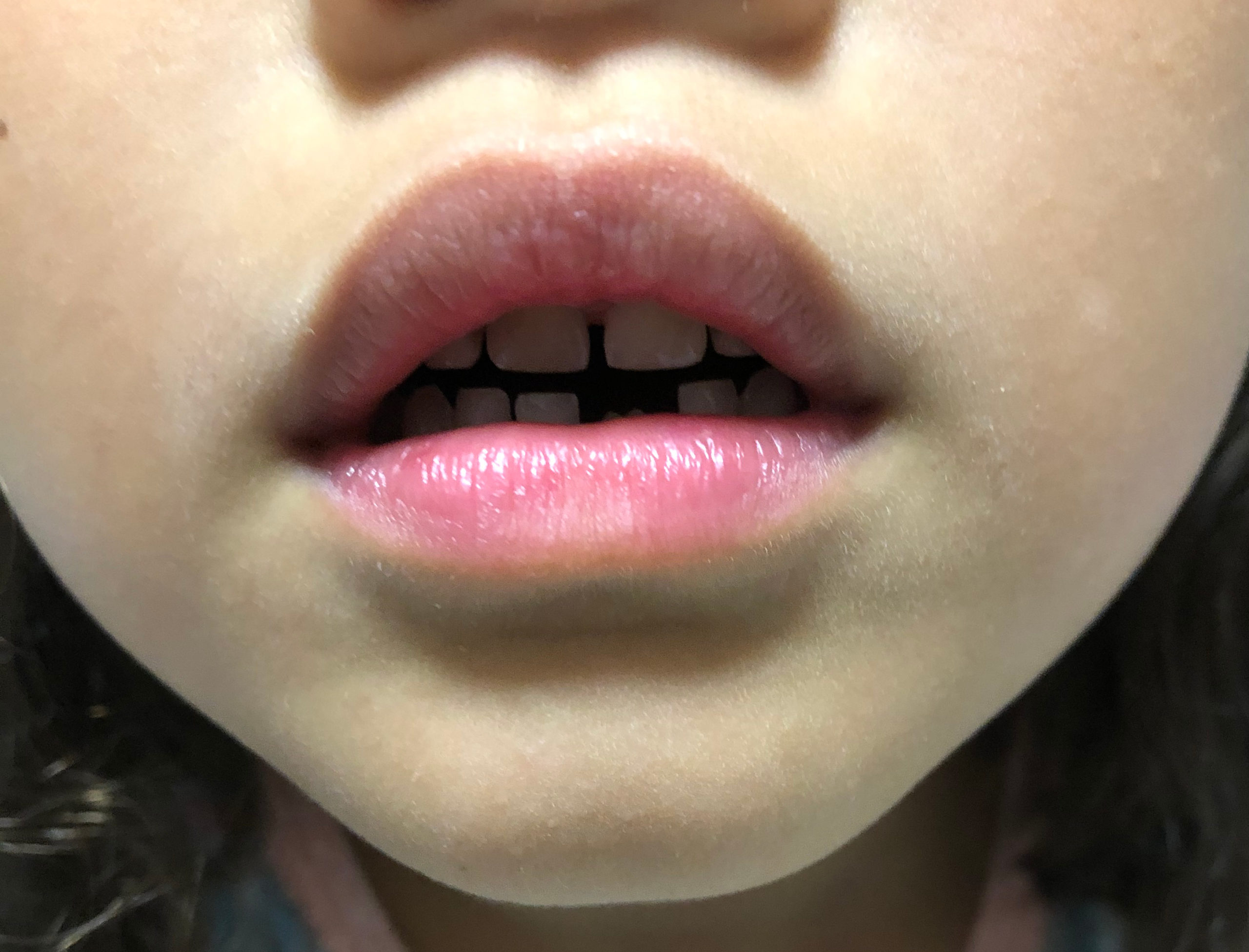 ポカン口の症例